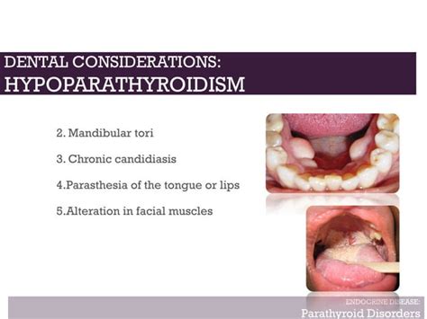 Endocrine Diseases And Its Dental Management Ppt