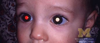 Treatment for leukoplakia, if needed, involves removing the source of irritation. RETINOBLASTOMA | Sonalism- It's different