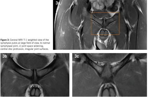 Aspetar Sports Medicine Journal Imaging In Long Standing Groin Pain
