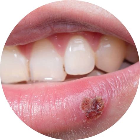 Cold Sore or Canker Sore? | Total Care Dental | Holistic Dentistry