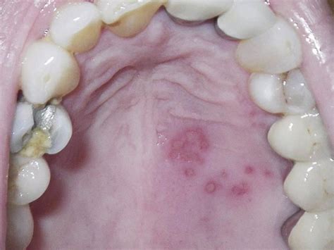 Oral Manifestations Of Viral Infections Atlas Of The Oral And