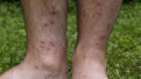 Coronavirus vaccine passes a crucial first test. Sting of Summer: Protect Yourself Fom Bites and Burns ...