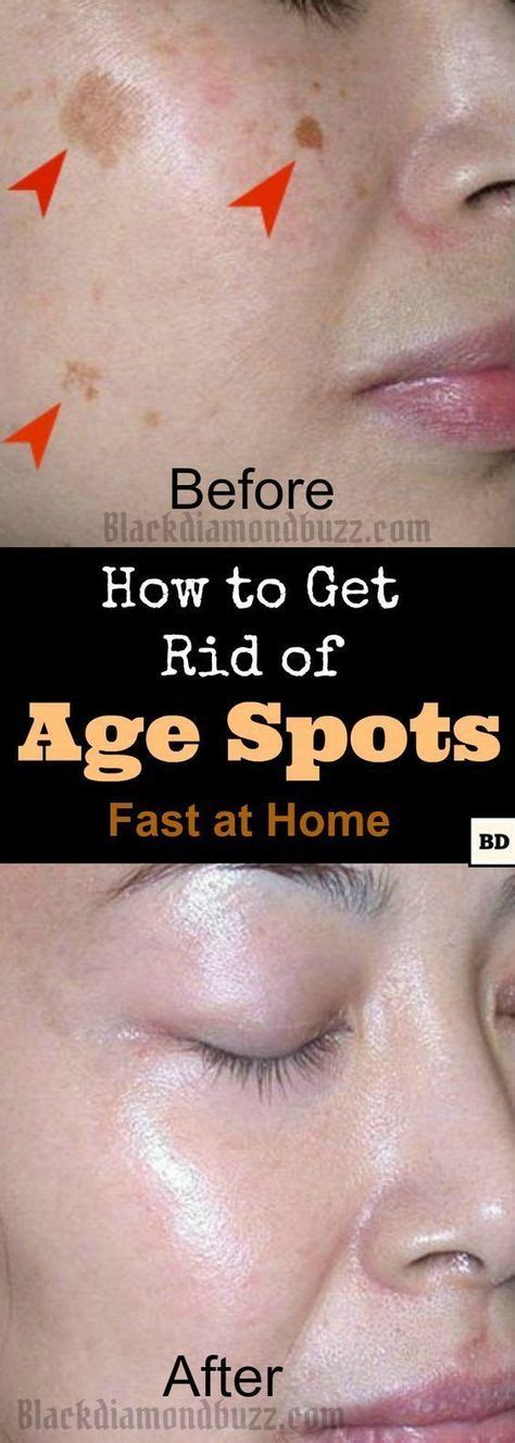 Diy Age Spots Removal This How To Get Rid Of Age Spots On Face Fast
