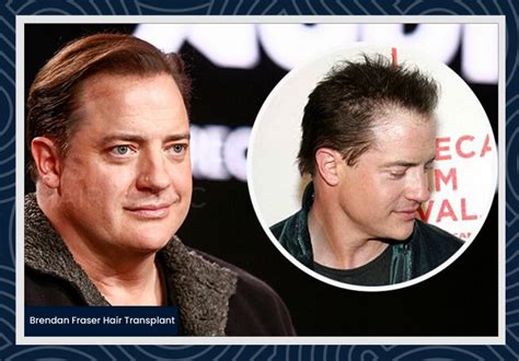 Celebrities Hair Transplants Smile Hair Clinic