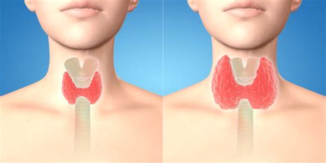 3d Render Of Normal Thyroid Glands And Goiter In The Human Female Body