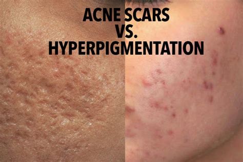 How To Get Rid Of Acne Scars On Face Dermatologist