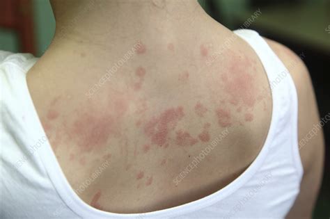 Allergic Dermatitis Stock Image F0372014 Science Photo Library