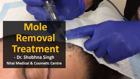 Mole Removal Treatment Using Ellman Machine Nitai Medical Melbourne Youtube