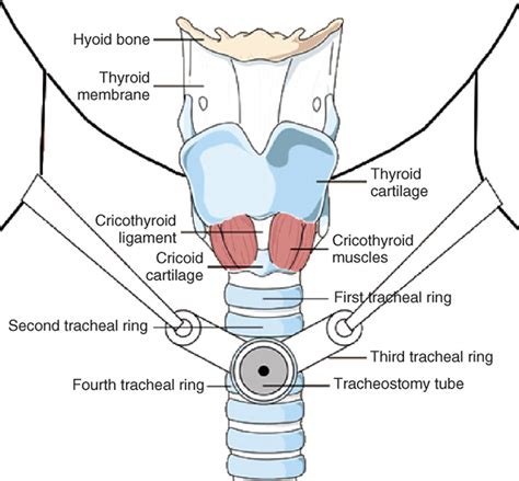 Tracheostomy Anatomy Of The Trachea With Stoma Larynx Posters For