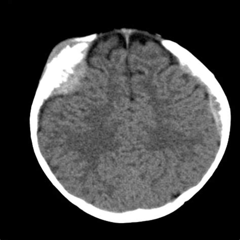 Neuroblastoma With Skull Metastases Image
