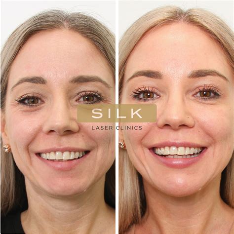 Silk Laser Clinics Skin Treatments And Laser Clinics
