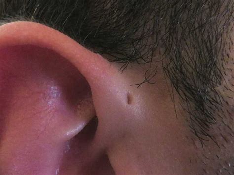 Preauricular Sinus And Cyst Wikiwand