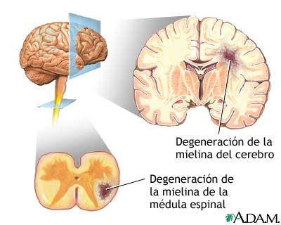 Causas inciertas de la esclerosis múltiple. Claves de Salud: Esclerosis múltiple: causas, dieta y ...