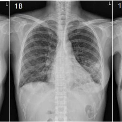 Serial Chest Radiographs Of The Patient The Baseline Chest Radiograph