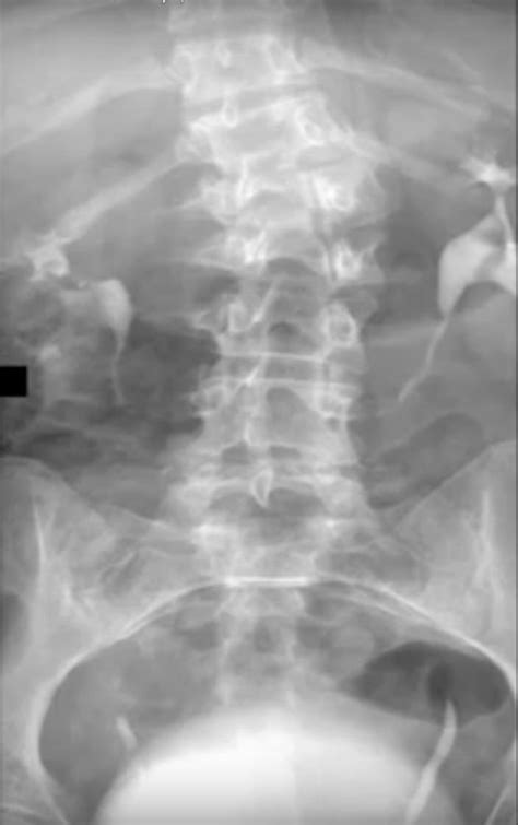 Frida painted her recollection of the last moments aboard the bus before the terrible accident that robbed her of her health. Frida Kahlo im Kunstmuseum Gehrke-Remund Baden-Baden