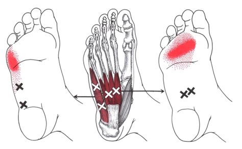 Foot Pain Intrinsic Muscles Trigger Points Try West Suburban Pain Relief
