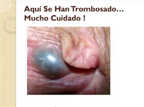 Maybe you would like to learn more about one of these? El Tratamiento Para Hemorroides - Digale Bye Bye A Sus ...