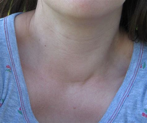 About 1 in 10 thyroid nodules turn out to be cancer. Celebrity Life Style: Thyroid Nodule is one of the