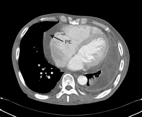 The tcg player app has an excellent scanner in it. Preoperative chest CT shows pericardial effusion. PE ...