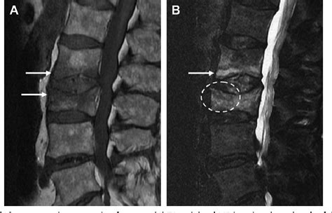 Figure 4 From Imaging Of Stress Fractures Of The Spine Semantic Scholar