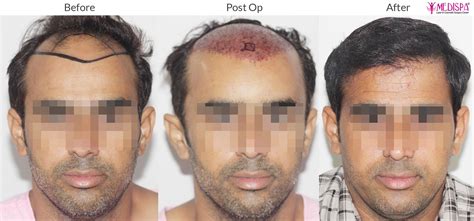 Top 181 Scalp Necrosis After Hair Transplant Polarrunningexpeditions
