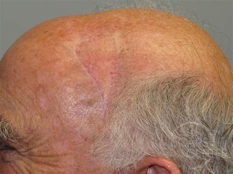 Scalp Reconstruction 4 - Skin Cancer and Reconstructive ...