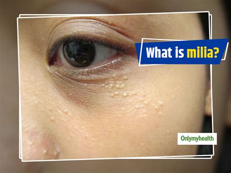 What Is Milia Ways To Get Rid Of These White Spots Onlymyhealth