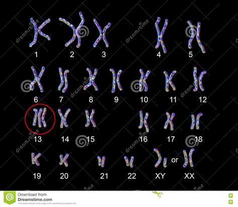 Patau Syndrome Karyotype Stock Illustration Illustration Of Genome 81595696