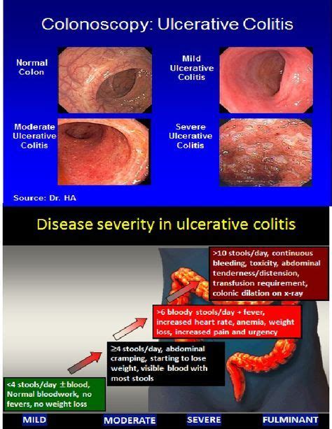 Side By Side Comparison Of Ulcerative Colitis Colonoscopy View With Symptoms Ulcerative