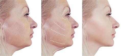 What Is The Difference Between A Facelift Neck Lift And