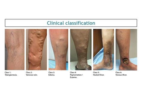 Classification Of Varicose Veins Dr Avinash Katara Minimal Access