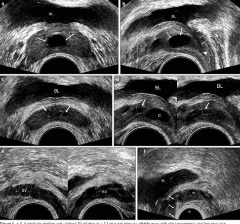 Figure 6 From Transrectal Us Guided Seminal Vesicle Aspiration In The