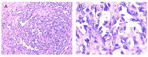 Frontiers Radiation Induced Sarcoma Of The Head And Neck Following