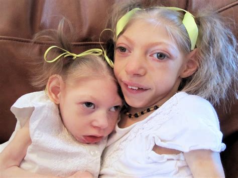 Microcephaly. Causes, symptoms, treatment Microcephaly