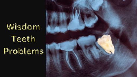 Wisdom Teeth Problems Diva Dental Clinic Bangalore