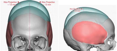 Plastic Surgery Case Study Two Stage Skull Augmentation With A Custom