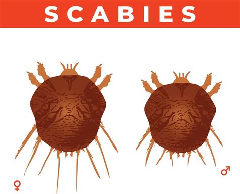 How To Tell If Scabies Is Going Away Top 5 Natural Remedies Icy Health