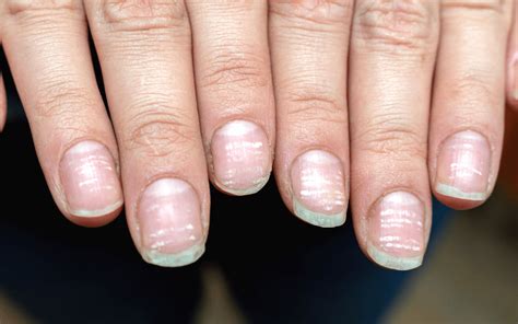 White Spots On Fingernails Causes Treatment Prevention