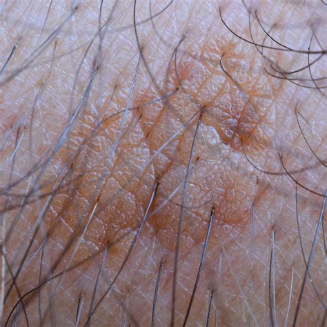 Seborrhoeic Keratoses Spot Check Skin Cancer Aesthetics Melbourne Cbd