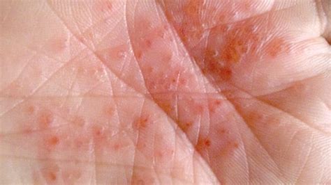 Tips To Prevent And Treat Palm Rashes