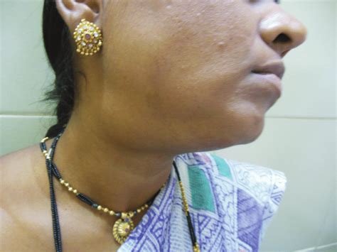 Photograph Of Patient With Submandibular Swelling Download