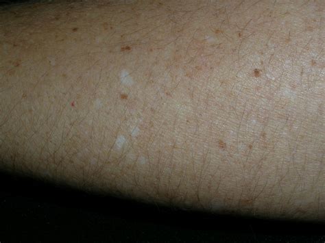 Small White Spots On Skin Cheapest Sale Save 58 Jlcatj Gob Mx
