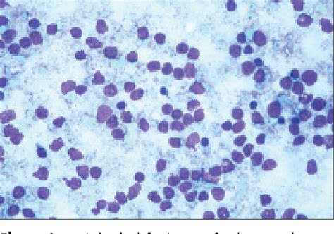 Figure 2 From Lymph Node Fine Needle Cytology In The Diagnosis Of