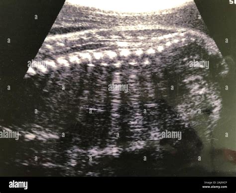 Fetal Ultrasound Showing Spine And Ribs Stock Photo Alamy