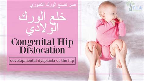 خلع الورك الولادي عسر تصنع الورك التطوري Congenital Hip Dislocation