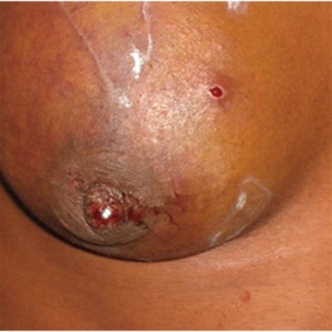 Breast Lump Showing A Bloody Nipple Discharge Skin Puncture Wound