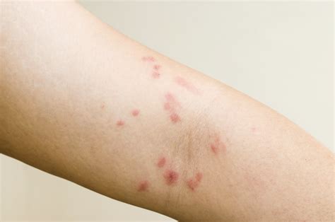 Our Guide To Rashes And Treatment Options Bronx Nyc