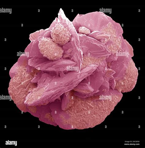 Bladder Stone Coloured Scanning Electron Micrograph Sem Of A Bladder