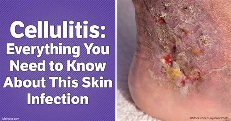 Cellulitis Everything You Need To Know About This Skin Infection