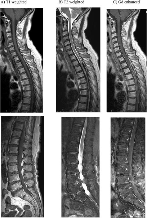 Sagittal T Weighted Mri Demonstrating A Widened Spinal Canal And My Xxx Hot Girl